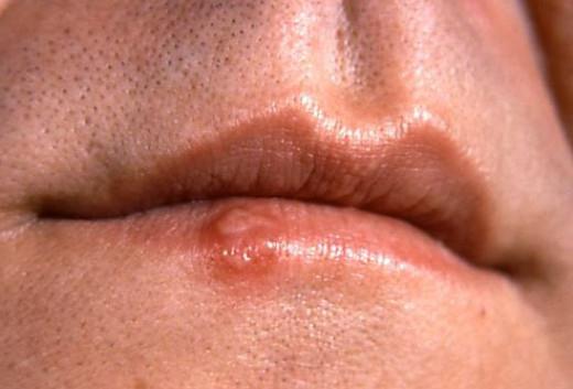 Lūpu vēža simptomi